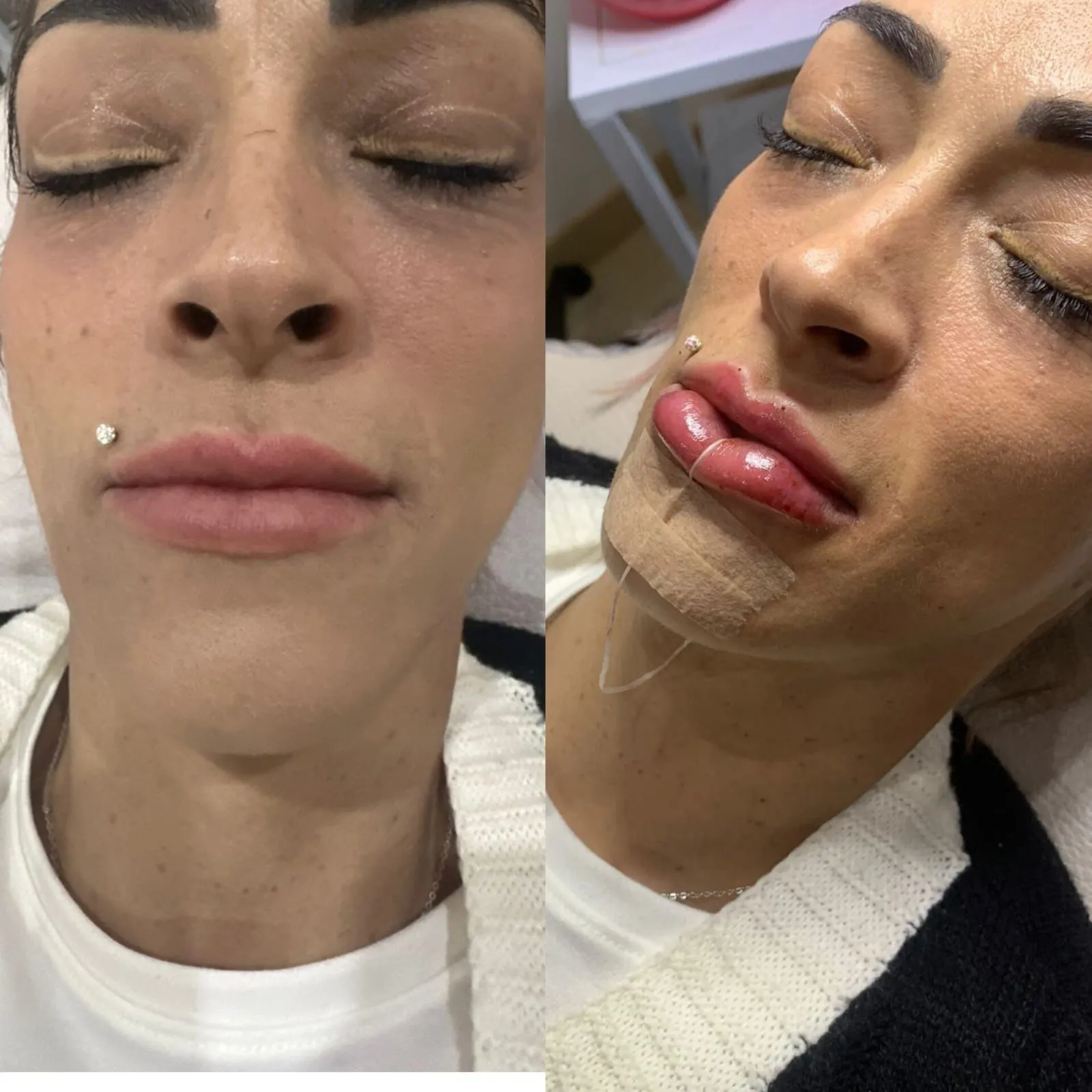 Aumento de labios - Imagen 1