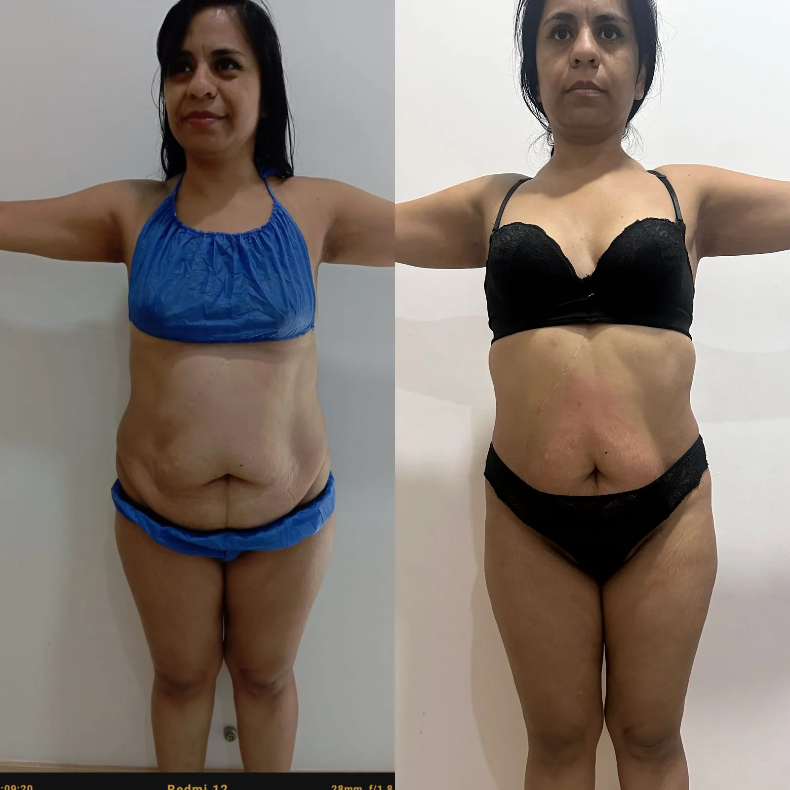 Tratamiento de reducción x 10 sesiones - Imagen 1