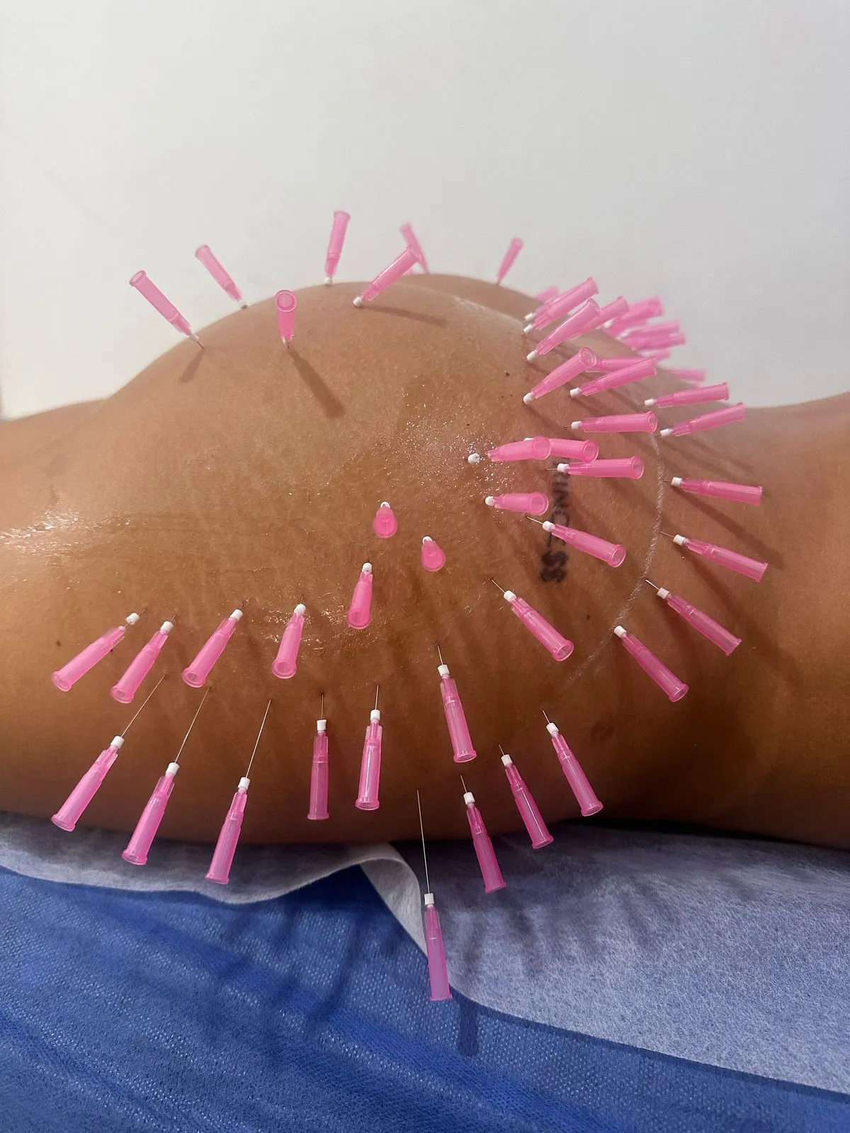 hilos de colageno o PDO