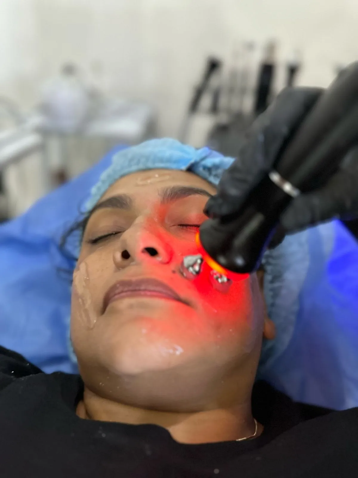 Porcelanizacíon Facial - Imagen 1