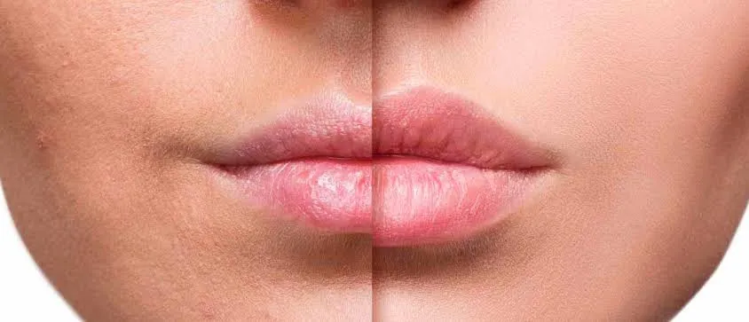 AUMENTO DE LABIOSAUMENTO DE LABIOS
