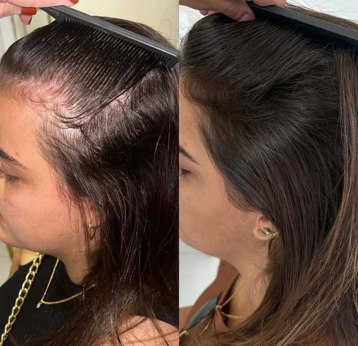 Terapia Anticaída
