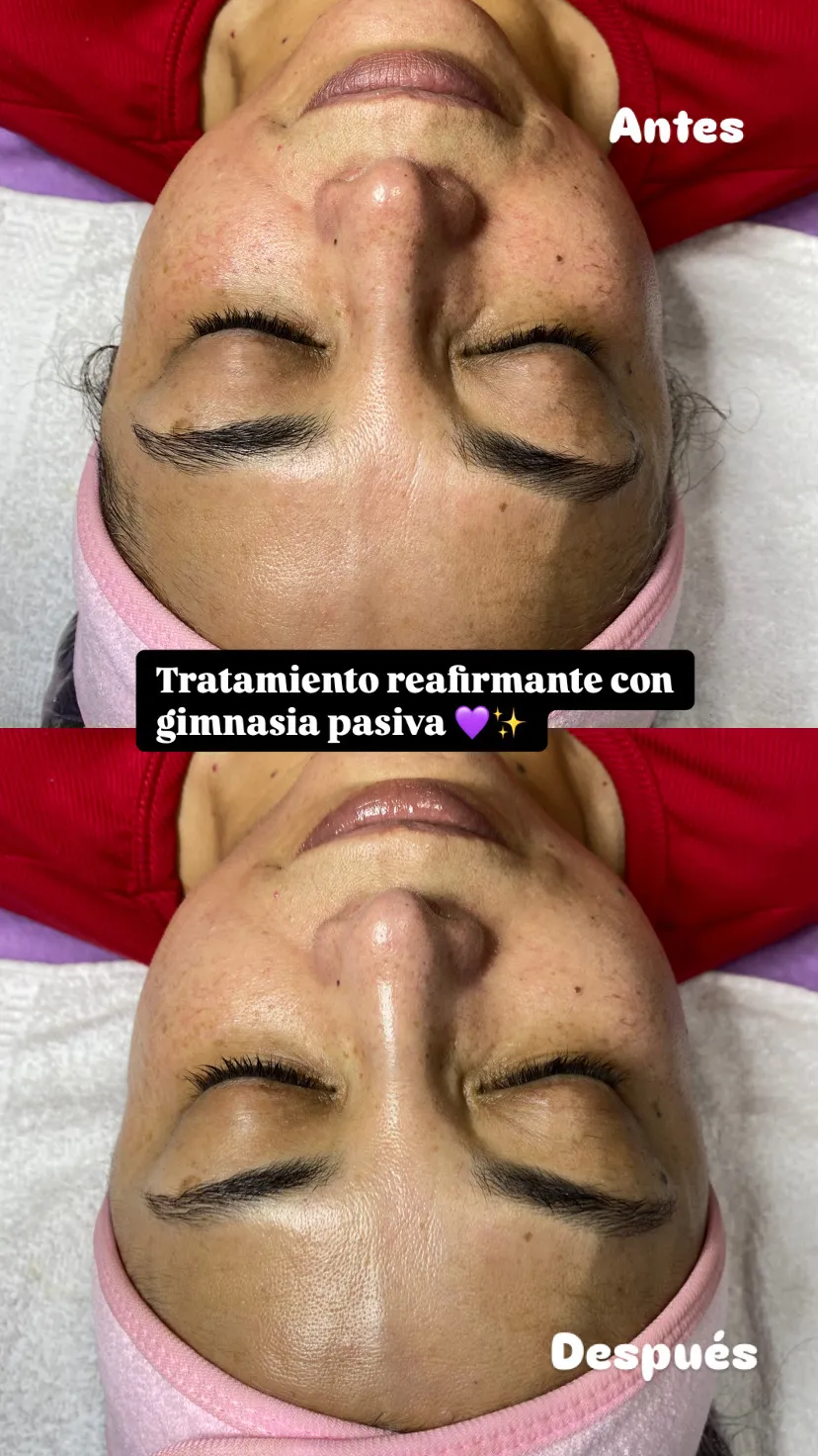 Rejuvenecimiento facial - Imagen 1
