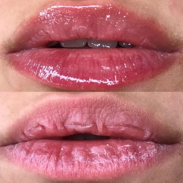 Hidralips - Imagen 1