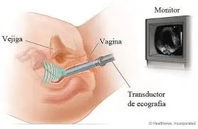 ECOGRAFIA TRANSVAGINAL