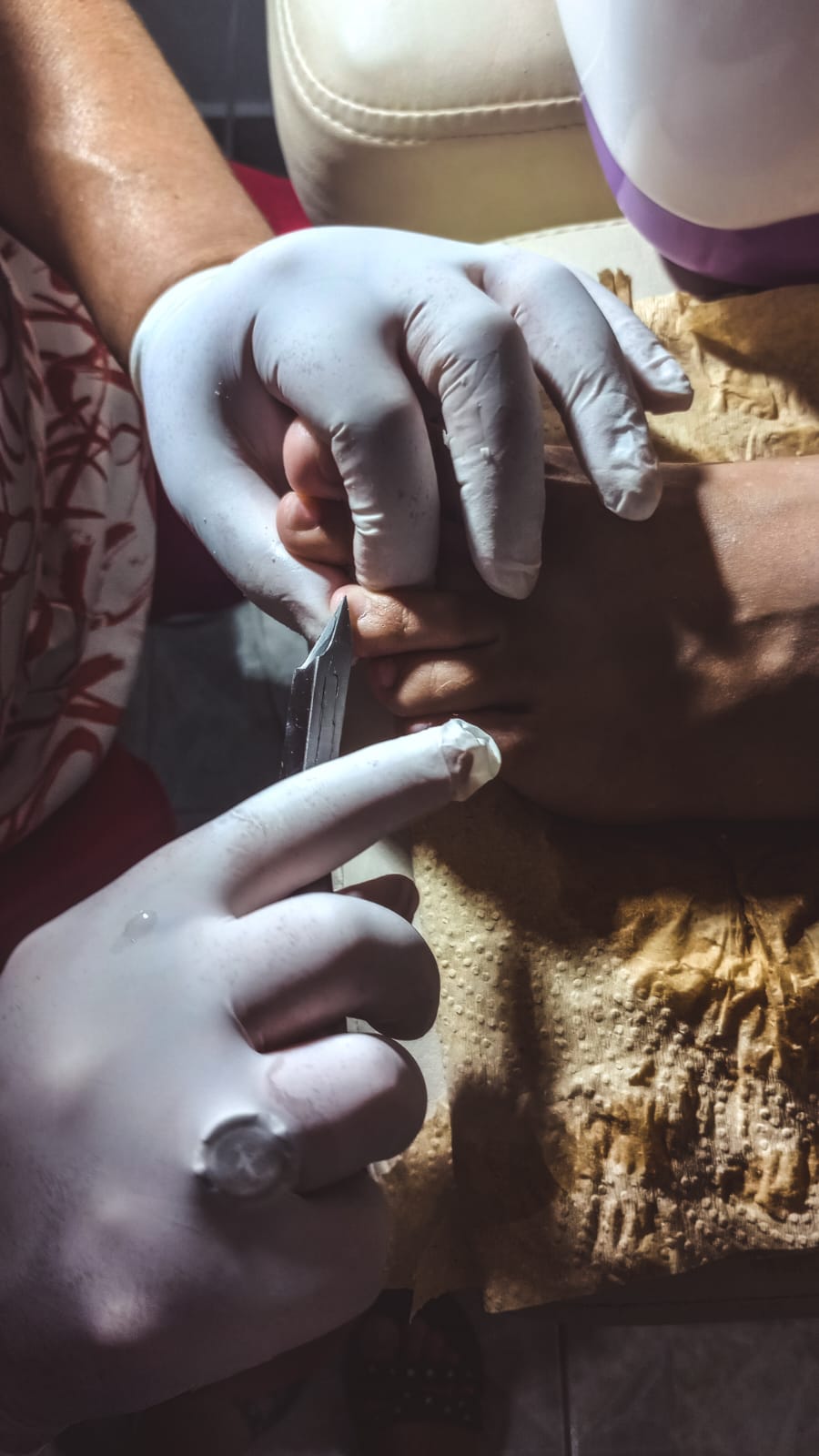 Pedicura Onicomicosis
