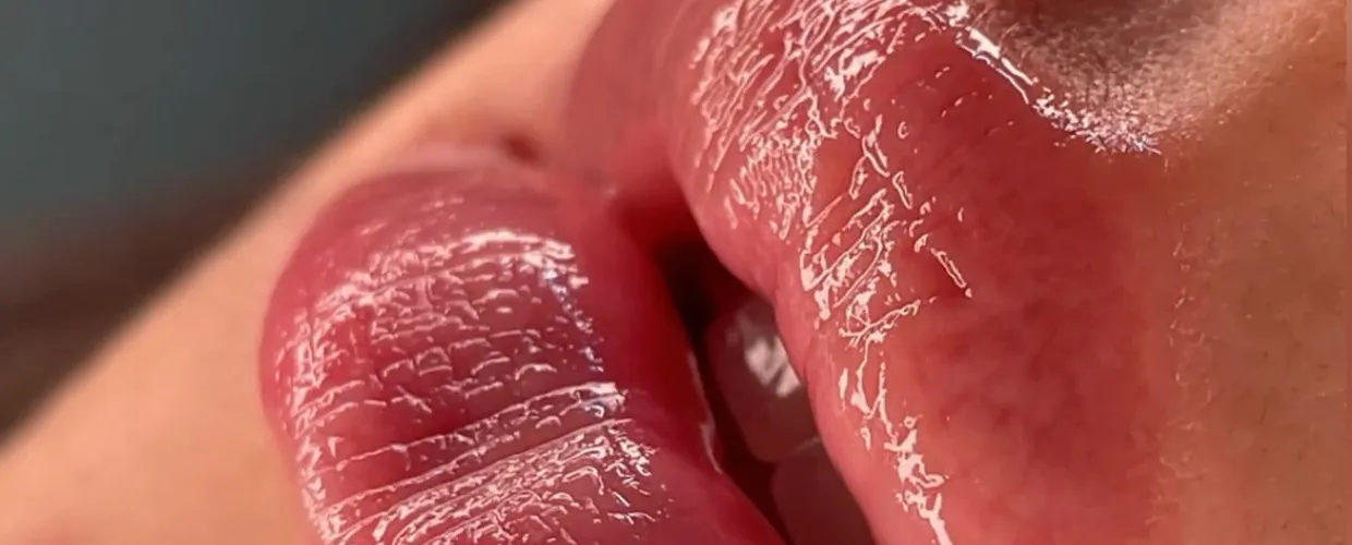 Hidralips - hidratación profunda de labios con dermapen