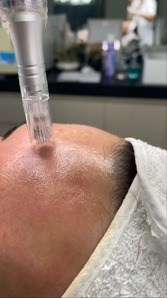 💉 Limpieza + Dermapen