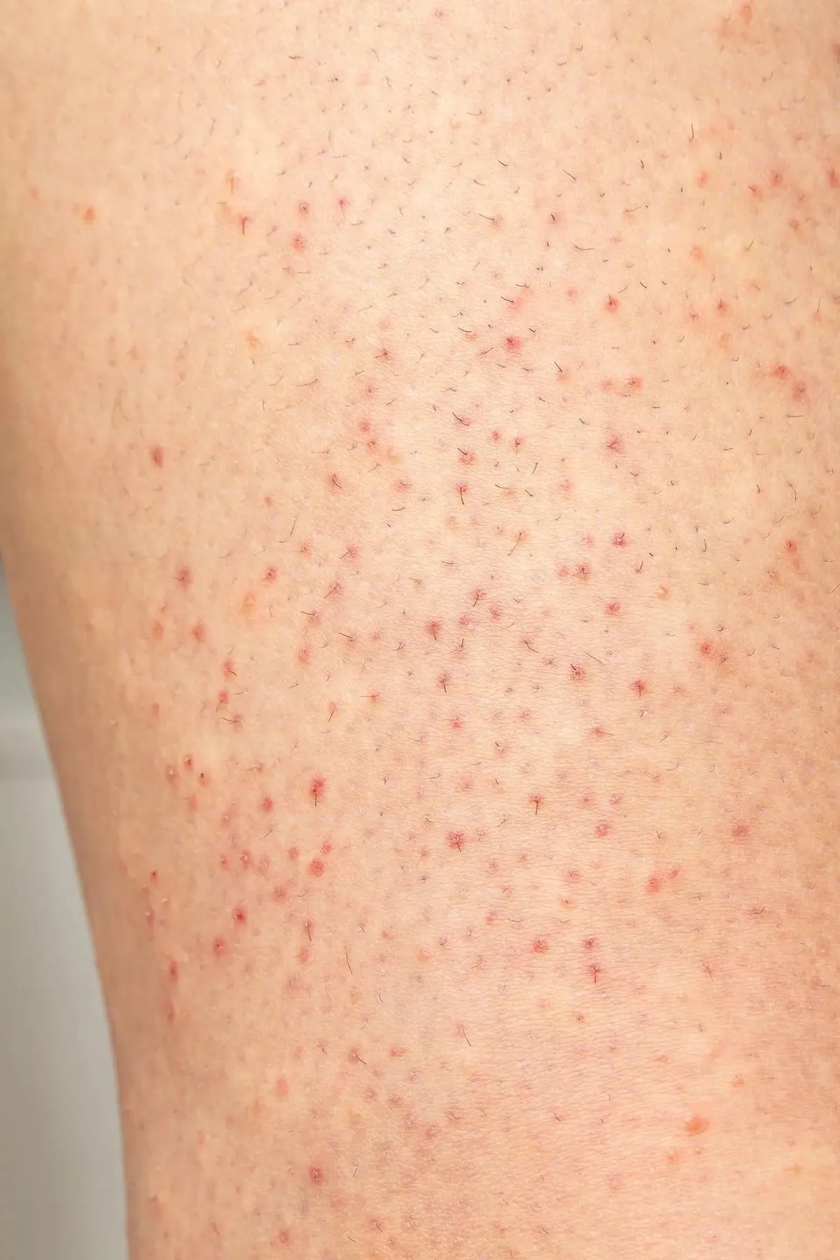 Tratamiento para foliculitis / (𝟐𝟎% 𝐨𝐟𝐟 𝐝𝐢́𝐚𝐬 𝐦𝐢𝐞𝐫𝐜𝐨𝐥𝐞𝐬)
