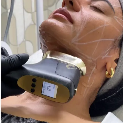 Hifu facial (6 de diciembre al 13 de diciembre) - Imagen 1