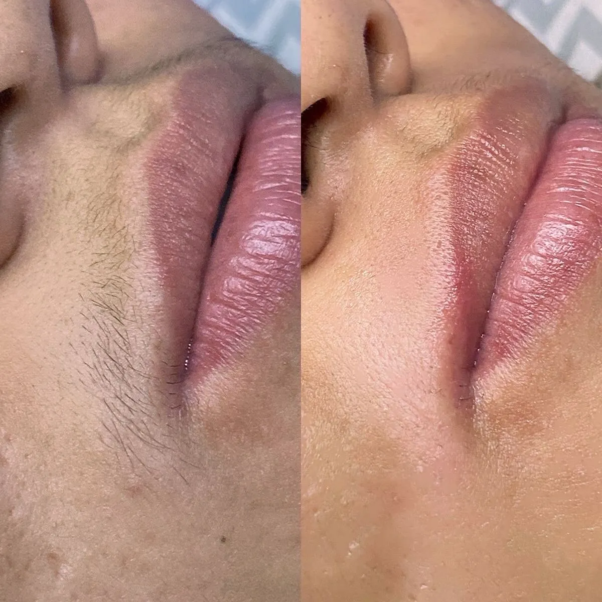 Depilación Facial (Por zona)