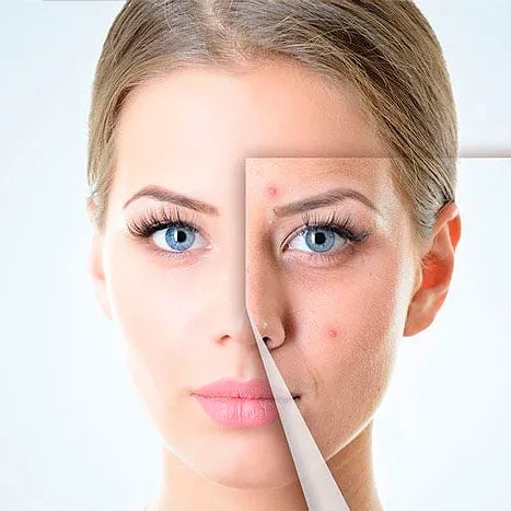 PAQUETE TRATAMIENTO ACNE