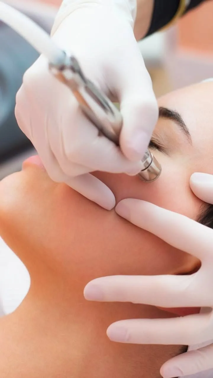 PEELING CON PUNTA DE DIAMANTE