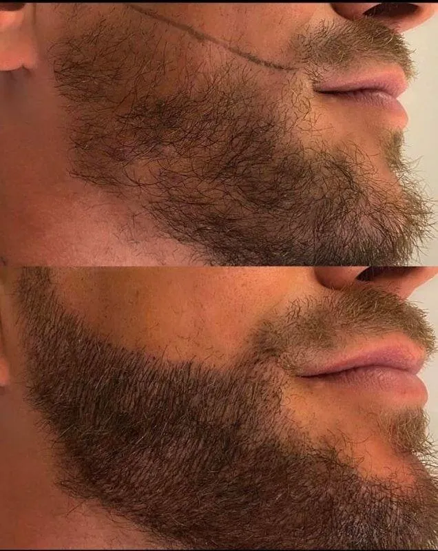 ◼️Pigmentación Barba - 2