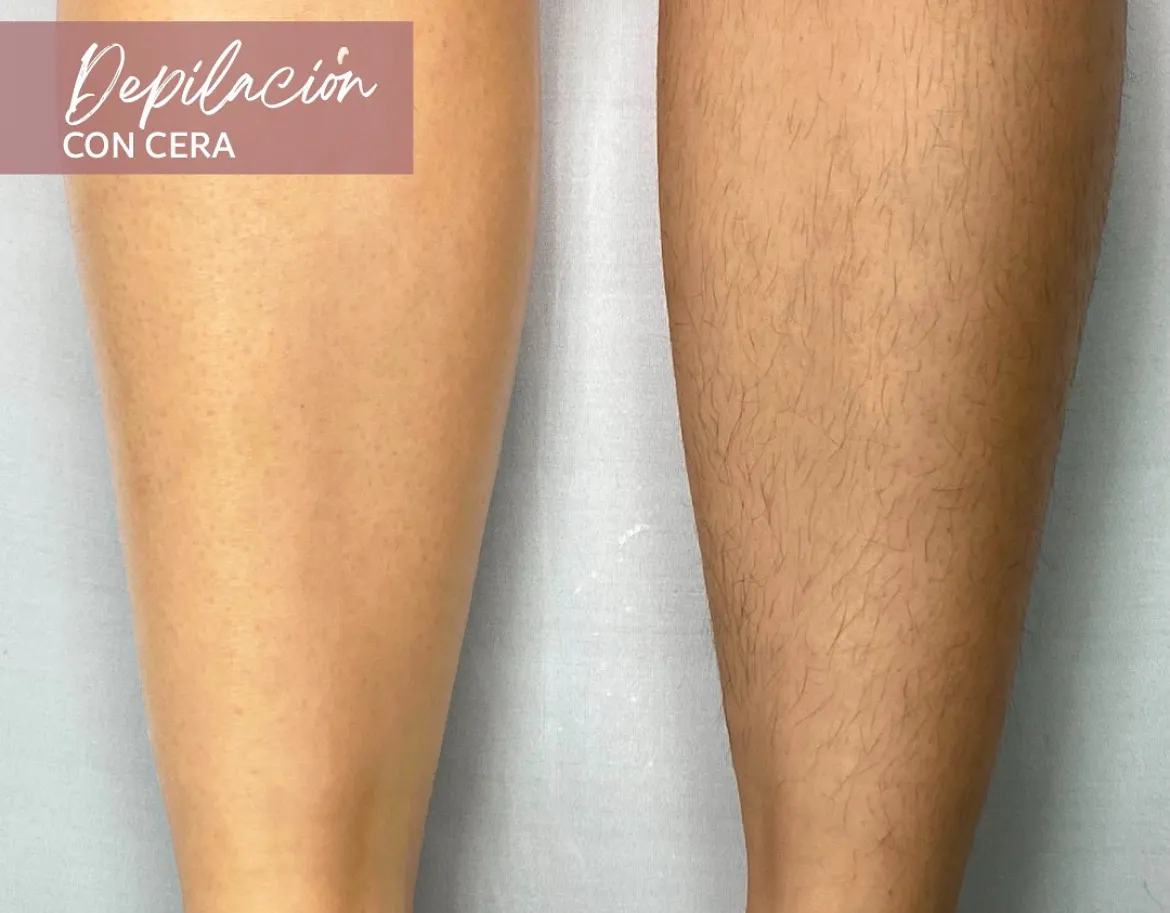 Depilación Corporal - Imagen 1