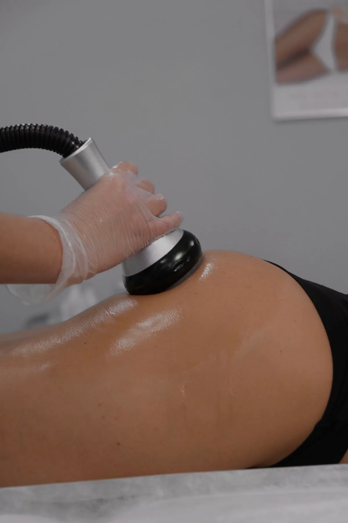 Tratamiento para glúteo