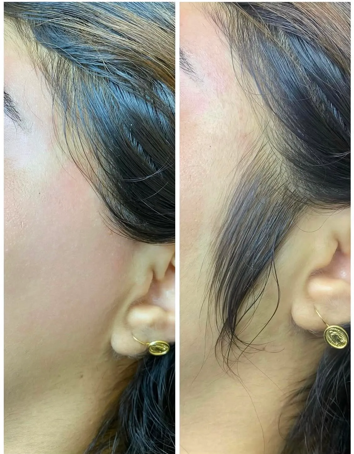 DEPILACIÓN DE PATILLAS