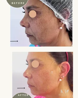 Endolifting laser x zona facial - Imagen 3