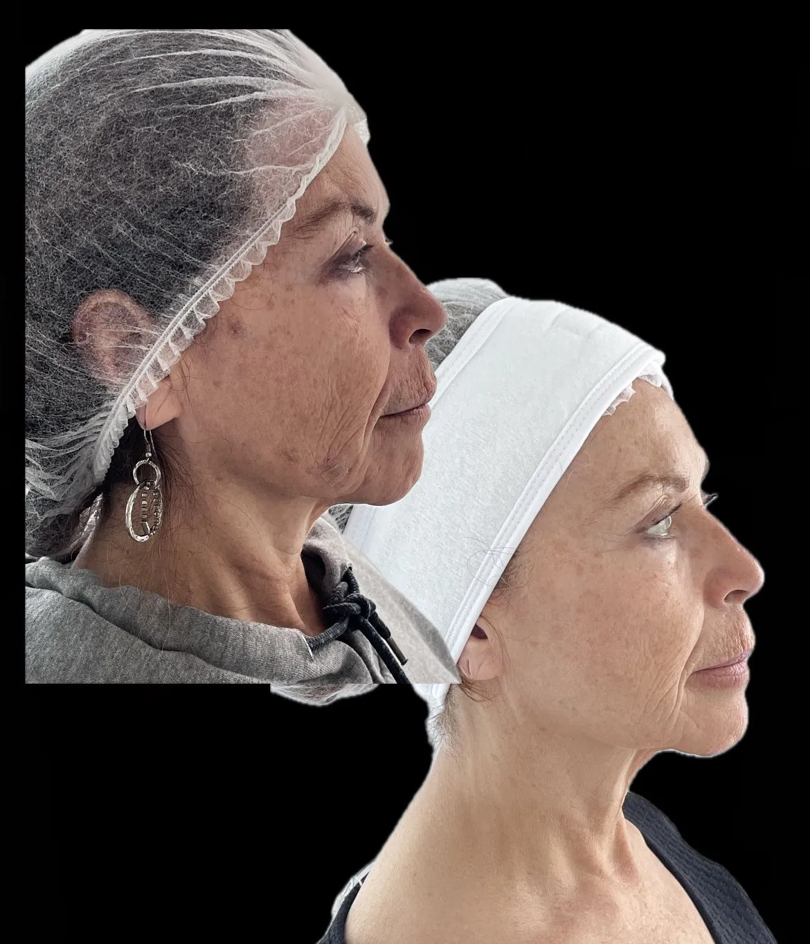 Endolifting laser x zona facial - Imagen 1