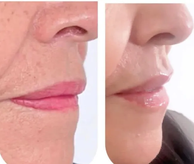 Escultura labial, armonizacion labial - 2