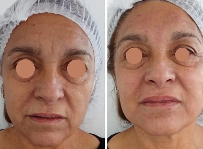 Profhilo face - Imagen 1