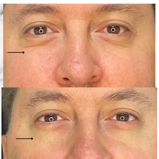 Endolifting laser x zona facial - Imagen 2