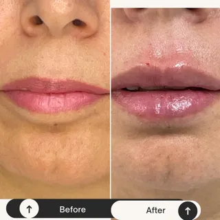 Escultura labial, armonizacion labial - 1