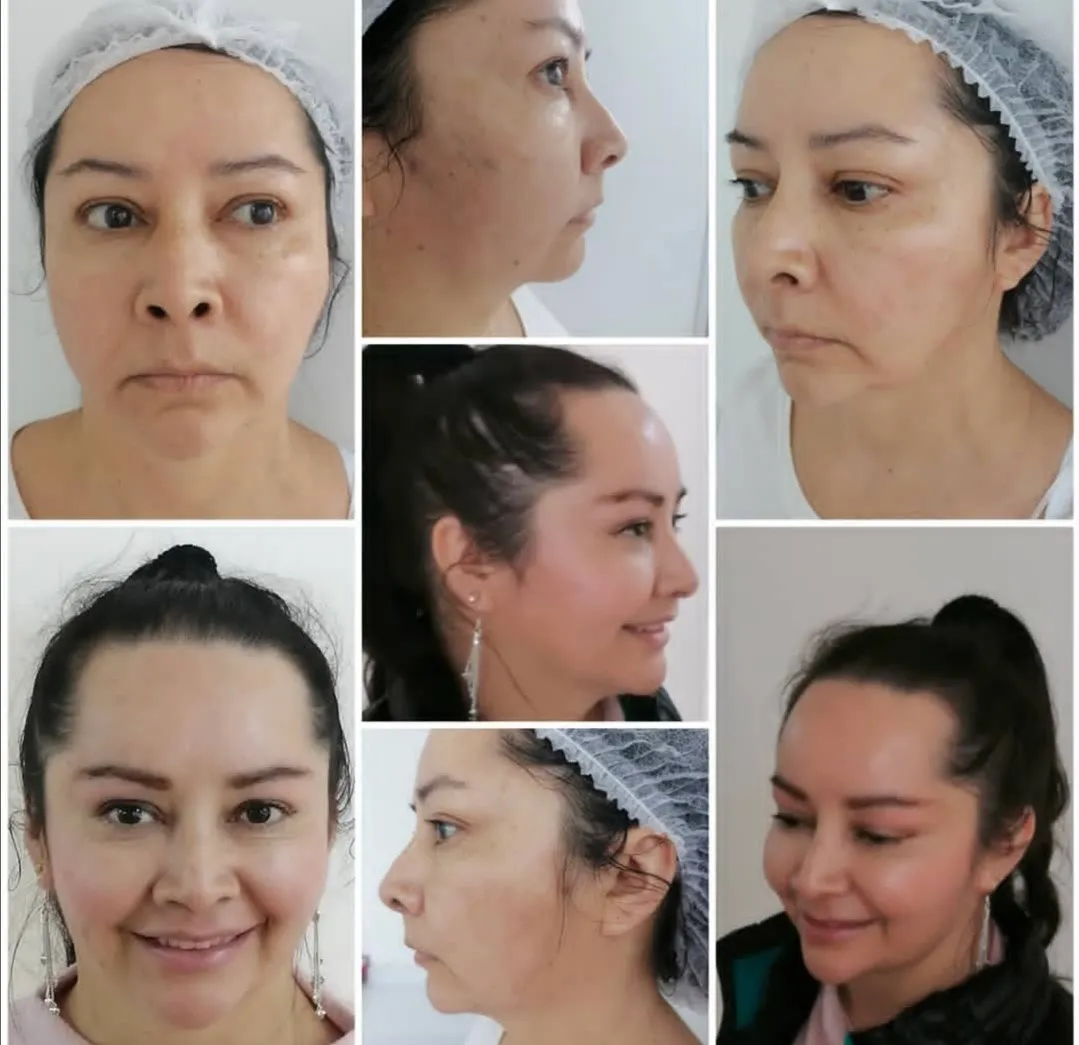 Armonizacion Facial Full Face - Imagen 1