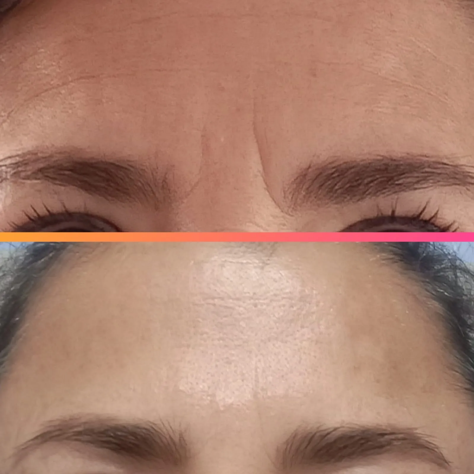 Toxina Botulinica (Bòtox) - Imagen 2