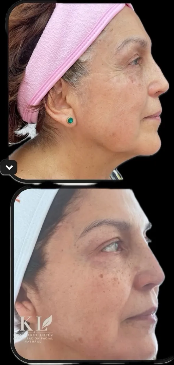 Hidroxiapatita De Calcio