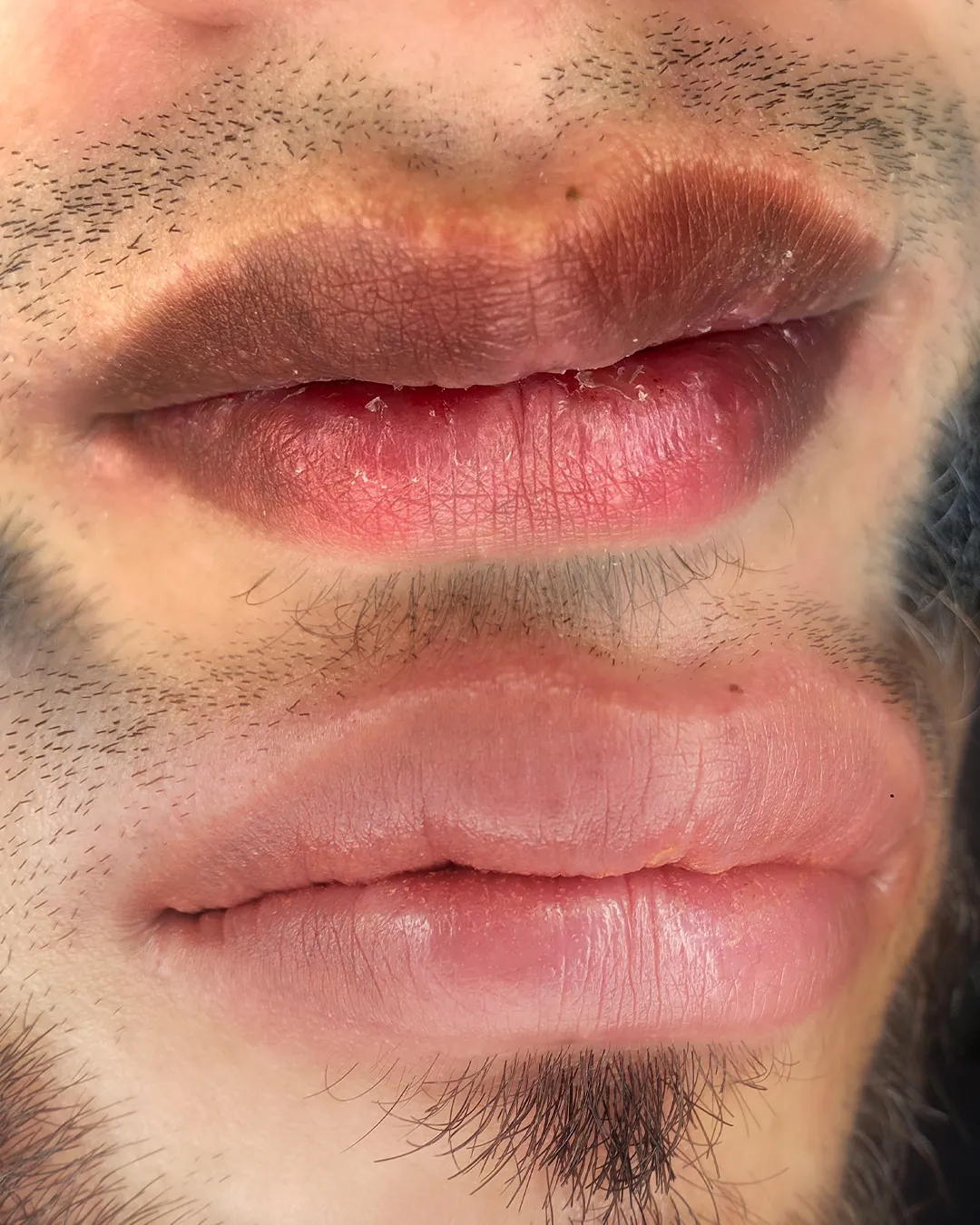 ***Neutralización De Labios