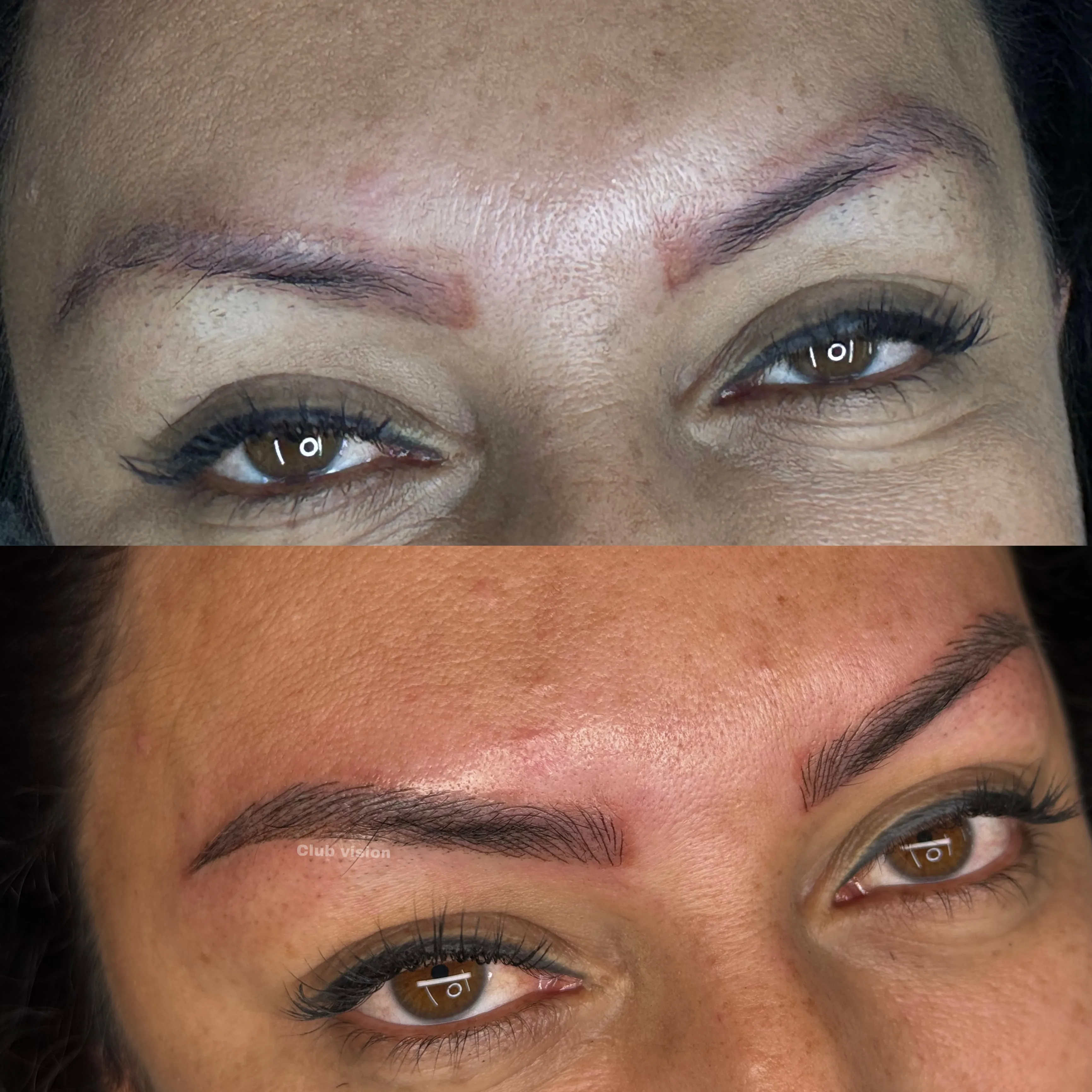 ***Despigmentación De Tatuaje - 5