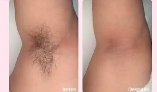 DEPILACION DE AXILAS CON CERA - 2
