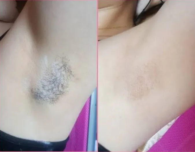DEPILACION DE AXILAS CON CERA - 1