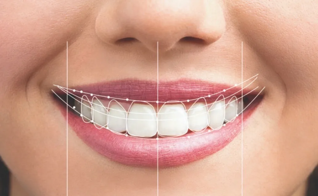 Diseño de Sonrisa en Materiales Cerámicos - Imagen 1