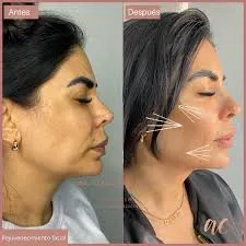 Lifting sin cirugía