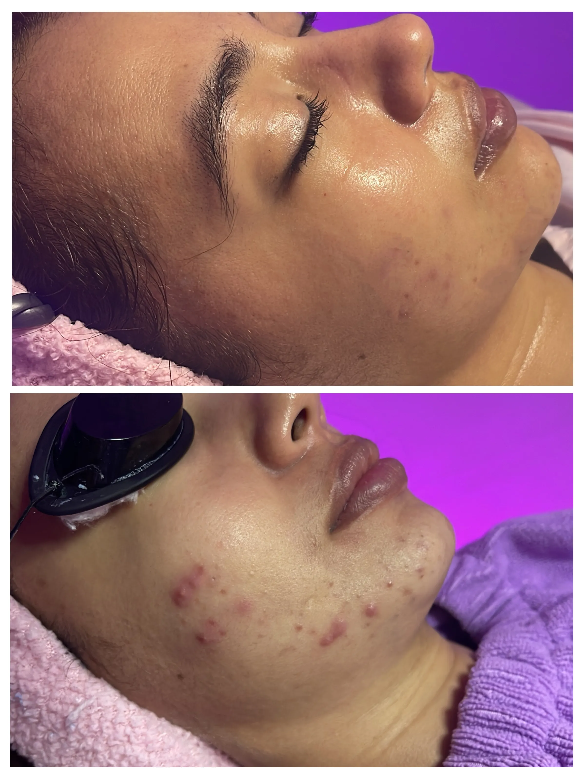 Acné moderado - Imagen 1