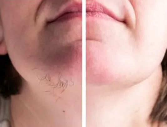 DEPILACIÓN DE BARBILLA - Imagen 1