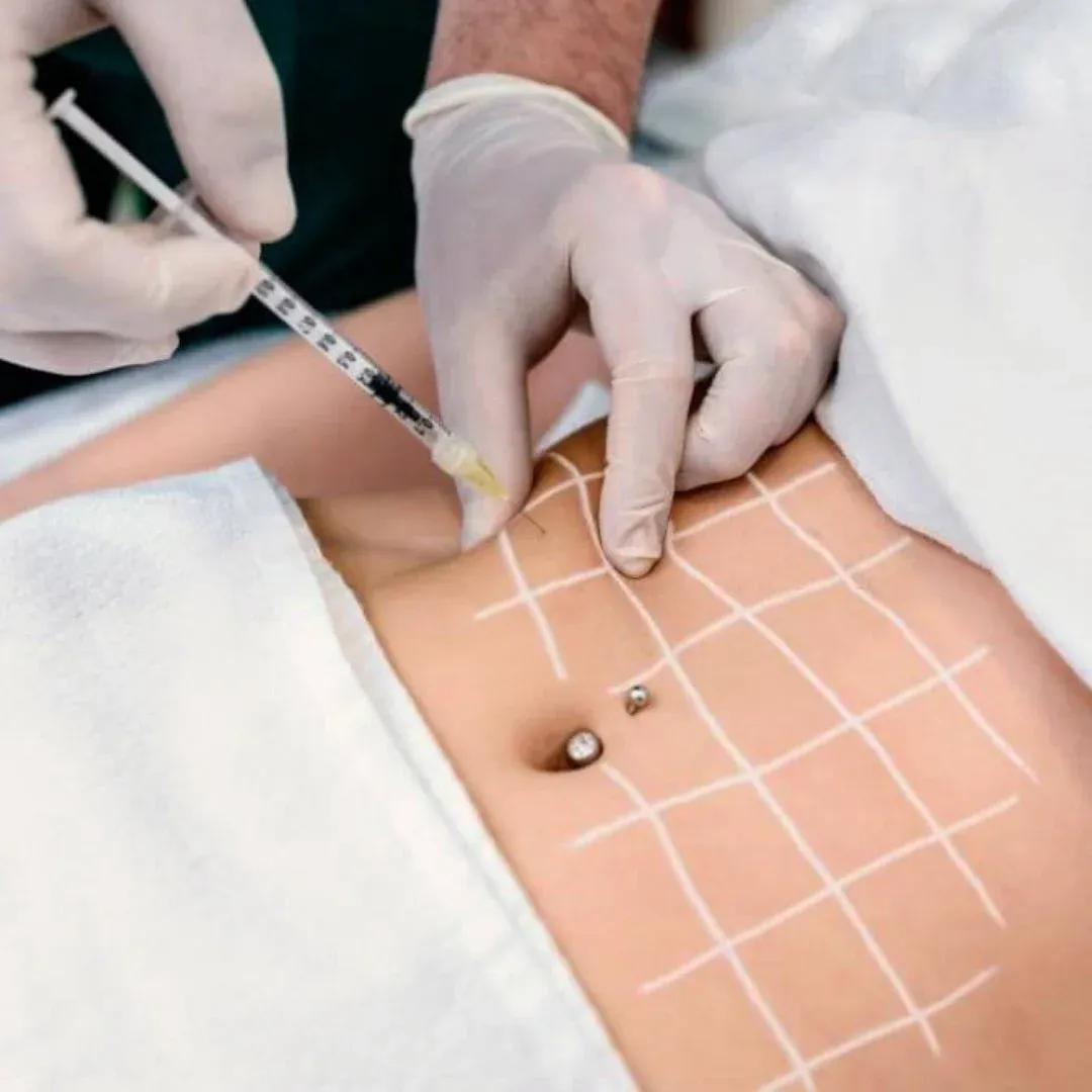 Mesoterapia Corporal + 2 sesiones cavitacion