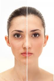 IPL  ACNE O FOTOREJUVENECIMIENTO 6 SESIONES EFECTIVO 1 ZONA