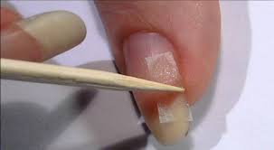 REPARACIÓN DE UÑA - Imagen 1