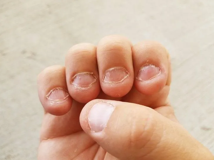 Tratamiento uñas mordidas + manicure pro