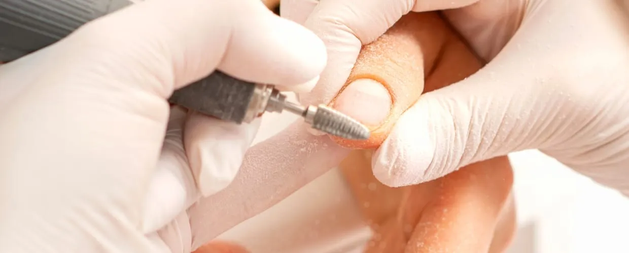 Retiro Kapping, nivelación o Softgel