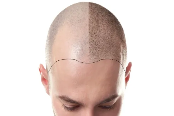 CAPILAR ALOPECIA 2 - Imagen 1