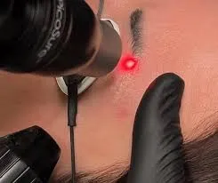 1 SESIÓN DE LASER