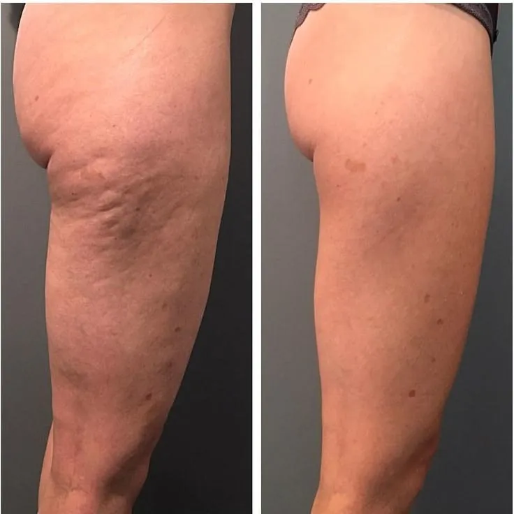 Tratamiento de celulitis