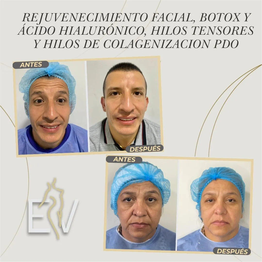 BOTOX 50und - 3