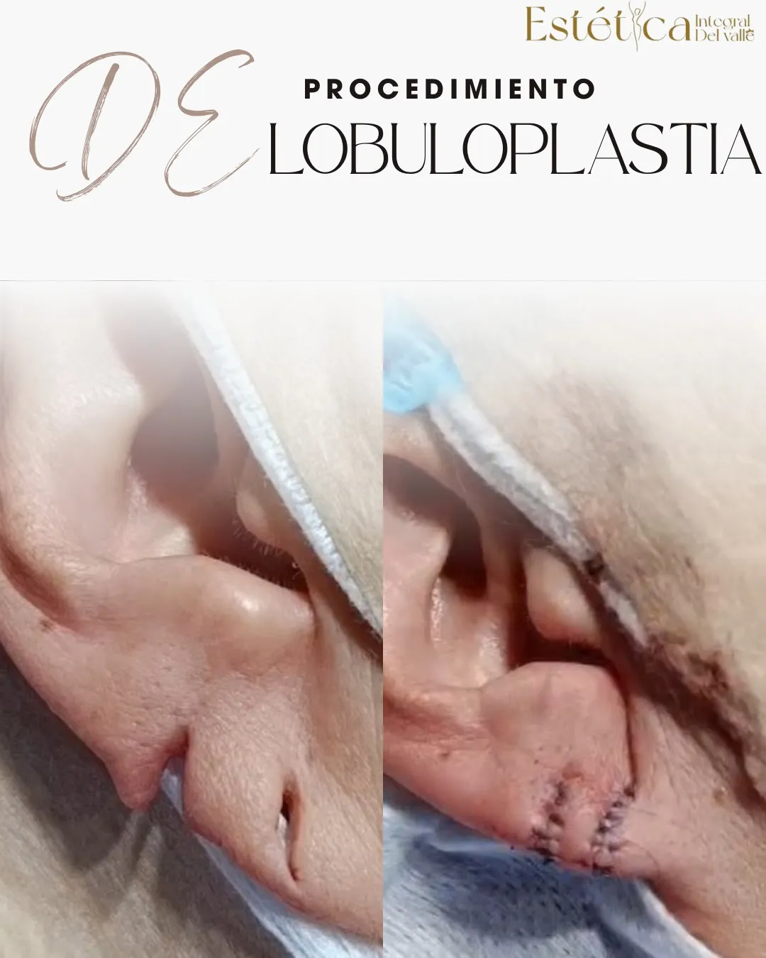 Lobuloplastia 1 orificio rasgado - 4