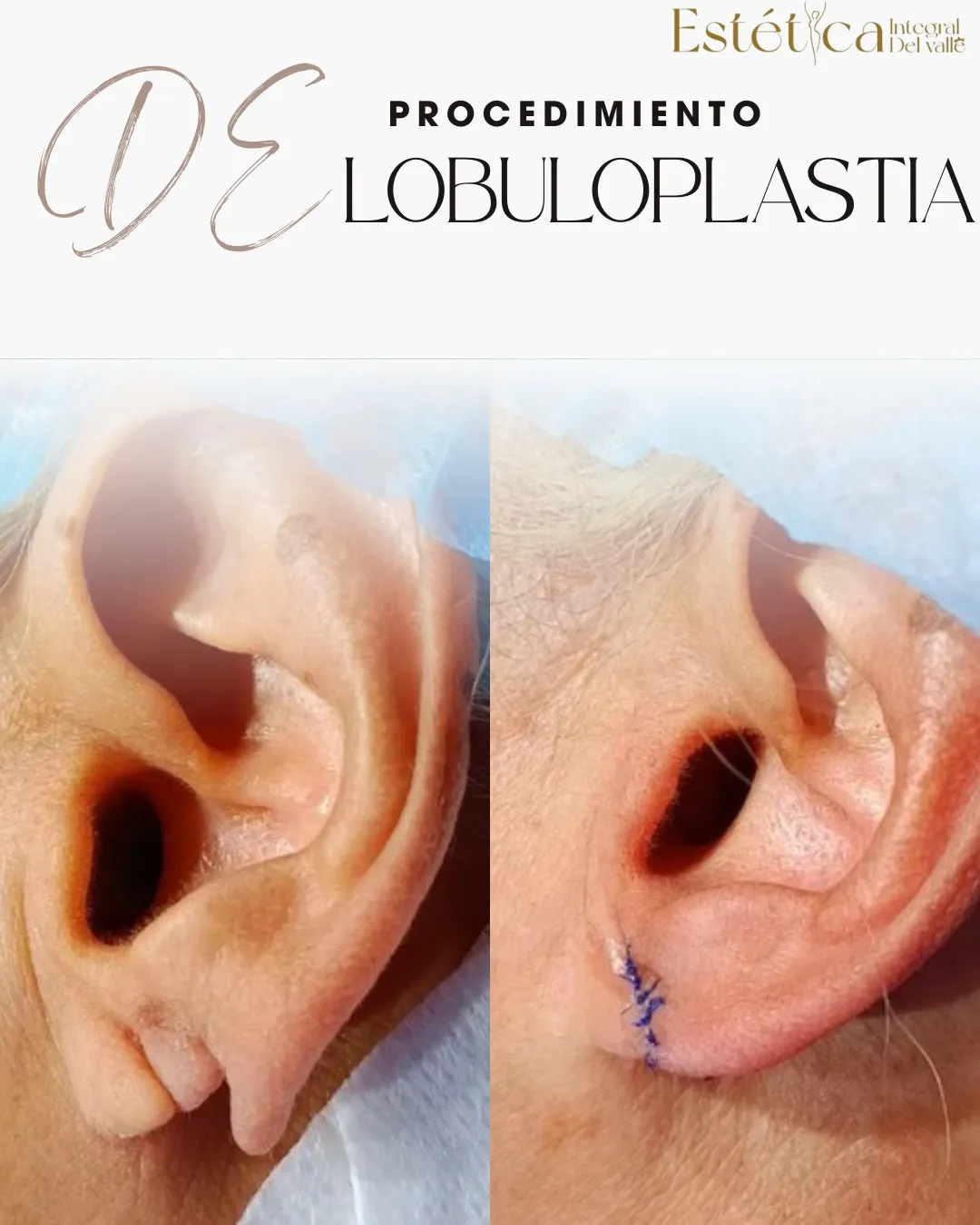 Lobuloplastia 1 orificio rasgado - 3