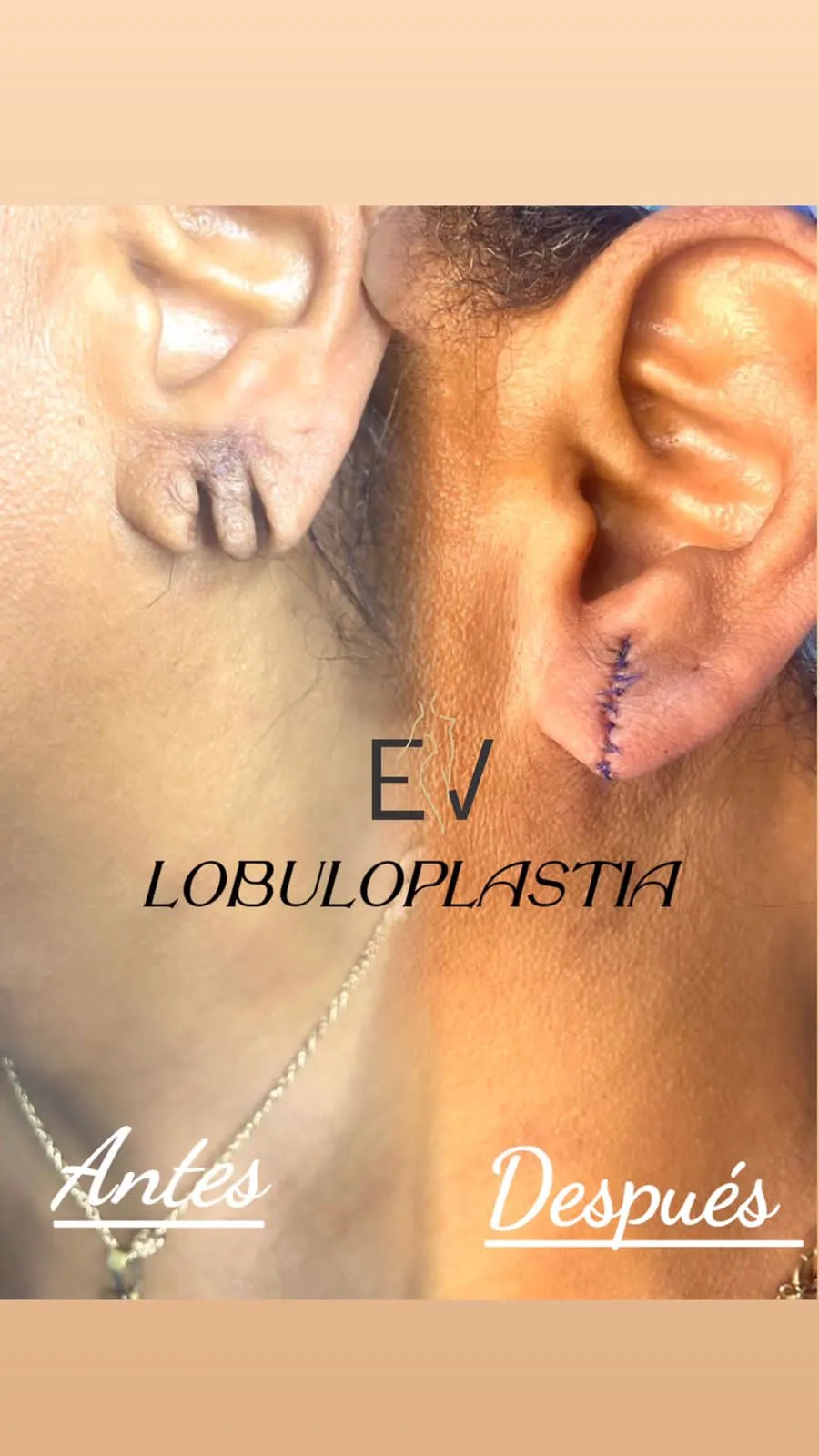 Lobuloplastia 1 orificio rasgado - 2